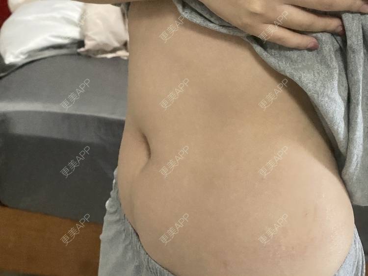 更美 - 更美用户IgJbVKY5D0的微针淡化妊娠纹经验 | 微针淡化妊娠纹 | 广州