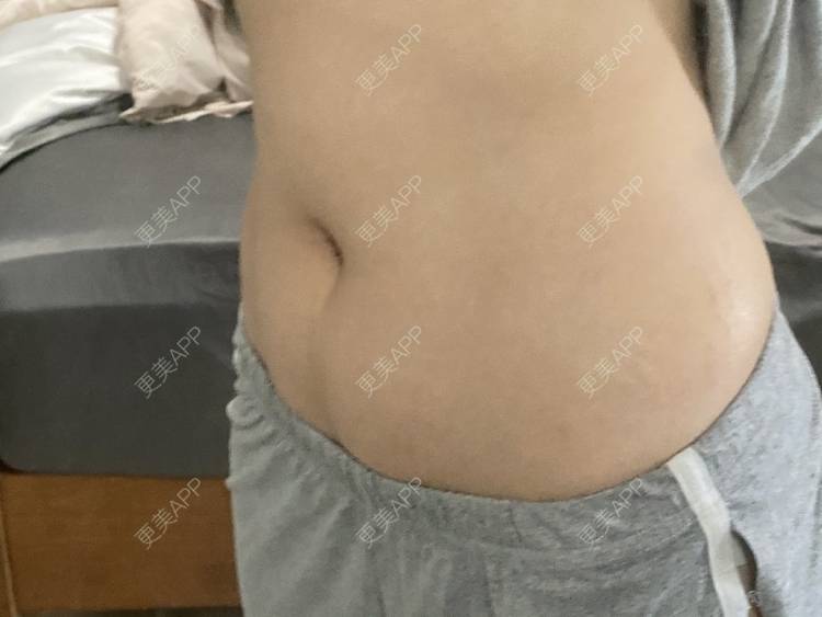 更美 - 更美用户IgJbVKY5D0的微针淡化妊娠纹经验 | 微针淡化妊娠纹 | 广州