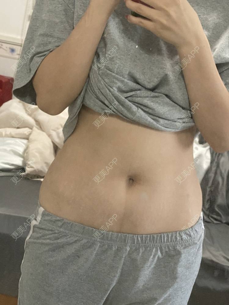 更美 - 更美用户IgJbVKY5D0的微针淡化妊娠纹经验 | 微针淡化妊娠纹 | 广州