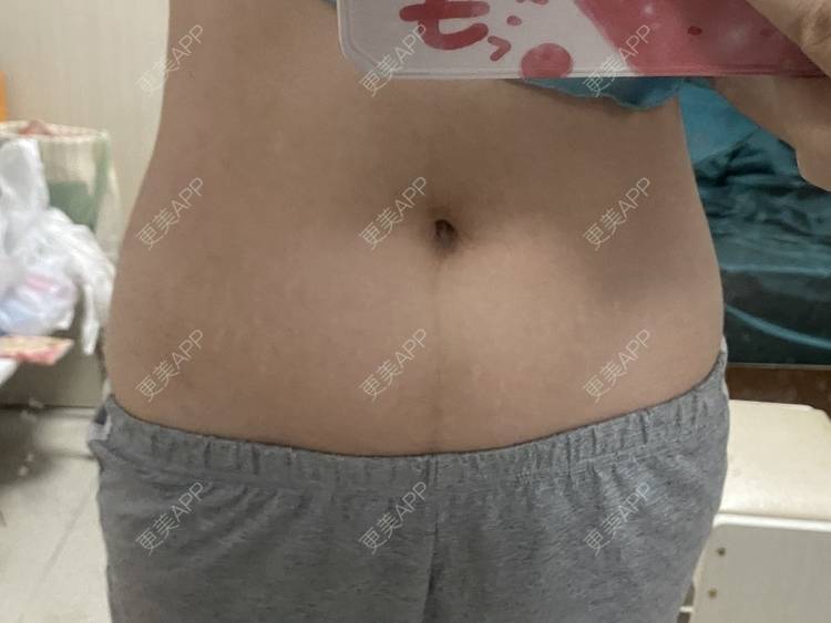 更美 - 更美用户IgJbVKY5D0的微针淡化妊娠纹经验 | 微针淡化妊娠纹 | 广州