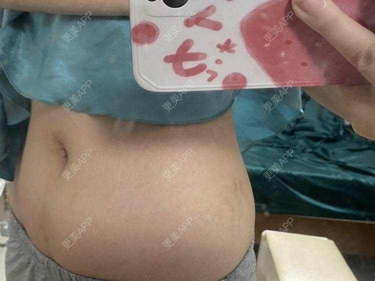 更美 - 更美用户IgJbVKY5D0的微针淡化妊娠纹经验 | 微针淡化妊娠纹 | 广州