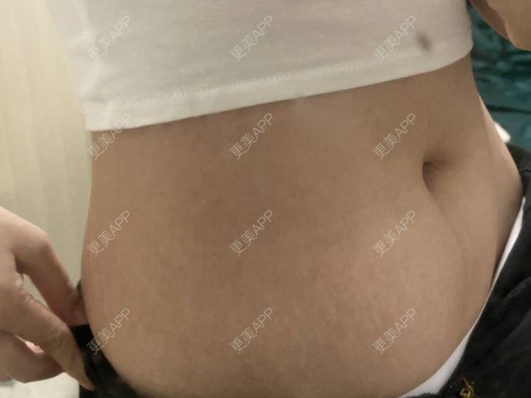 更美 - 更美用户IgJbVKY5D0的微针淡化妊娠纹经验 | 微针淡化妊娠纹 | 广州