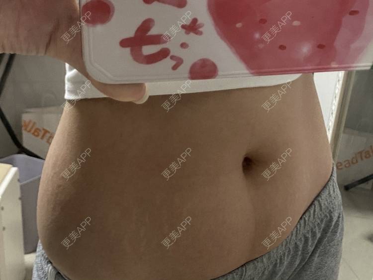 更美 - 更美用户IgJbVKY5D0的微针淡化妊娠纹经验 | 微针淡化妊娠纹 | 广州