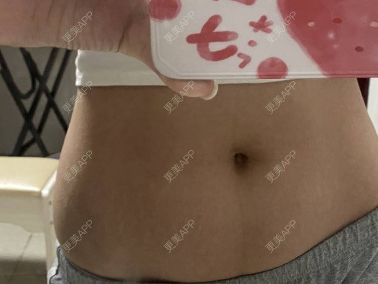 更美 - 更美用户IgJbVKY5D0的微针淡化妊娠纹经验 | 微针淡化妊娠纹 | 广州