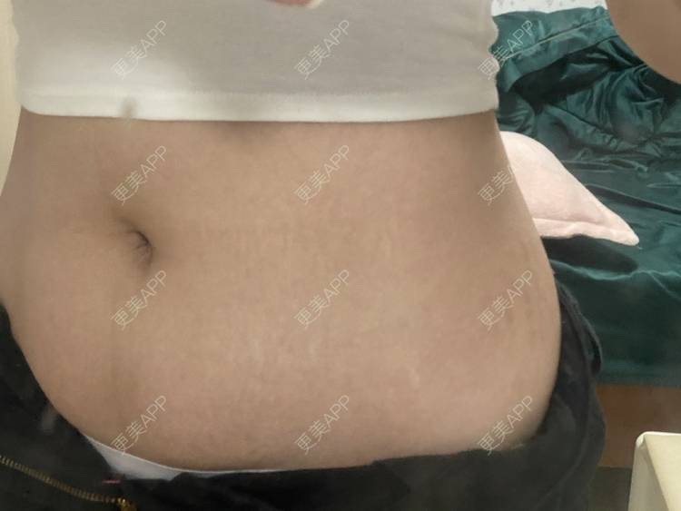 更美 - 更美用户IgJbVKY5D0的微针淡化妊娠纹经验 | 微针淡化妊娠纹 | 广州