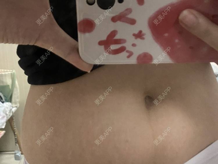更美 - 更美用户IgJbVKY5D0的微针淡化妊娠纹经验 | 微针淡化妊娠纹 | 广州