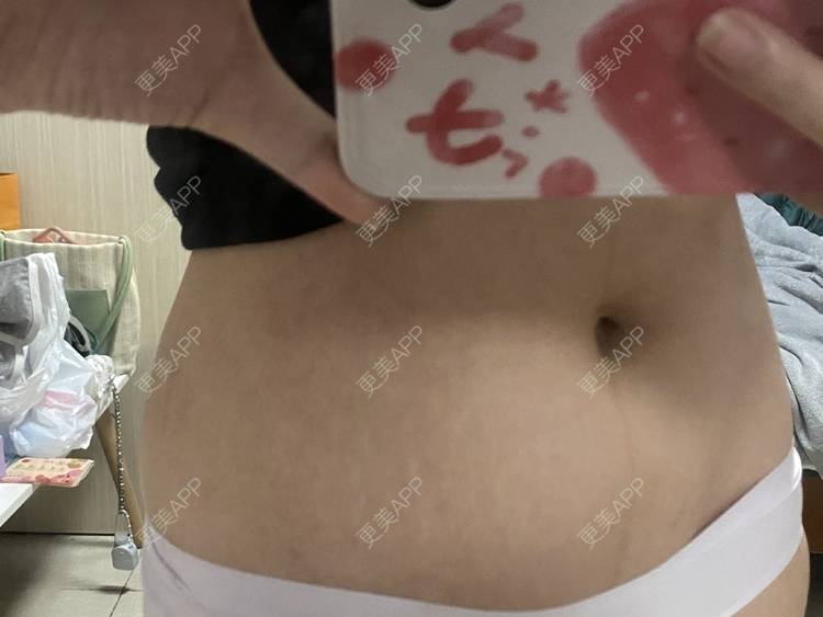更美 - 更美用户IgJbVKY5D0的微针淡化妊娠纹经验 | 微针淡化妊娠纹 | 广州