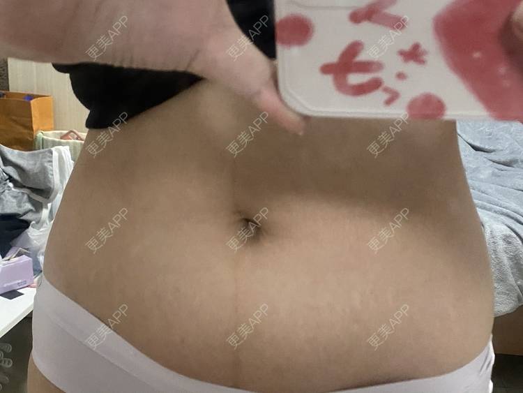 更美 - 更美用户IgJbVKY5D0的微针淡化妊娠纹经验 | 微针淡化妊娠纹 | 广州