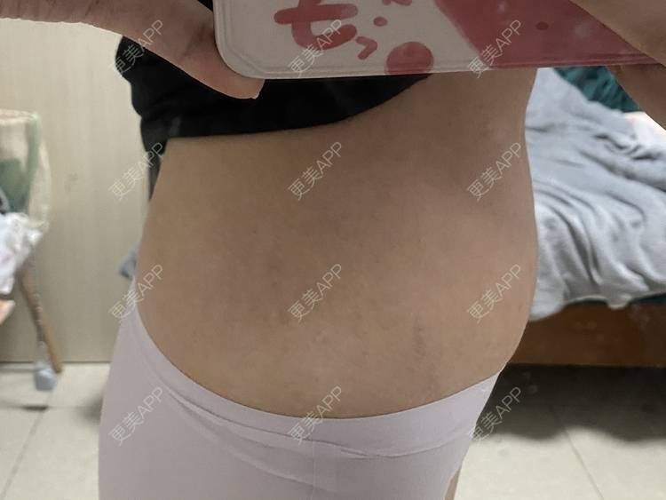 更美 - 更美用户IgJbVKY5D0的微针淡化妊娠纹经验 | 微针淡化妊娠纹 | 广州