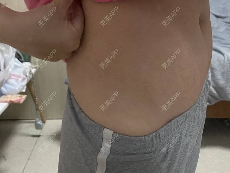 更美 - 更美用户IgJbVKY5D0的微针淡化妊娠纹经验 | 微针淡化妊娠纹 | 广州