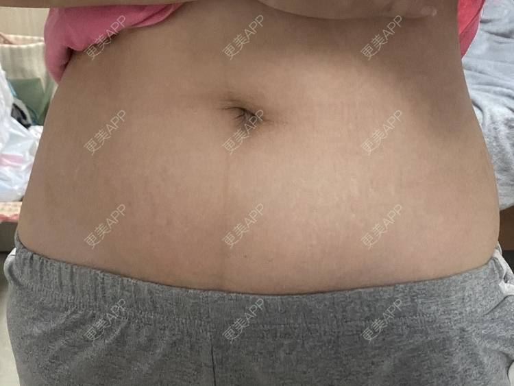 更美 - 更美用户IgJbVKY5D0的微针淡化妊娠纹经验 | 微针淡化妊娠纹 | 广州