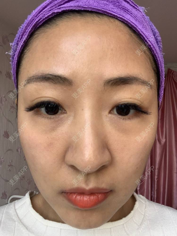 更美 - 房小丫的水光项目经验 | 水光项目 | 天津 | 微针水光