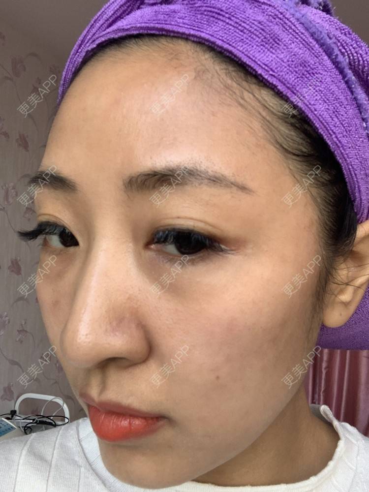 更美 - 房小丫的水光项目经验 | 水光项目 | 天津 | 微针水光