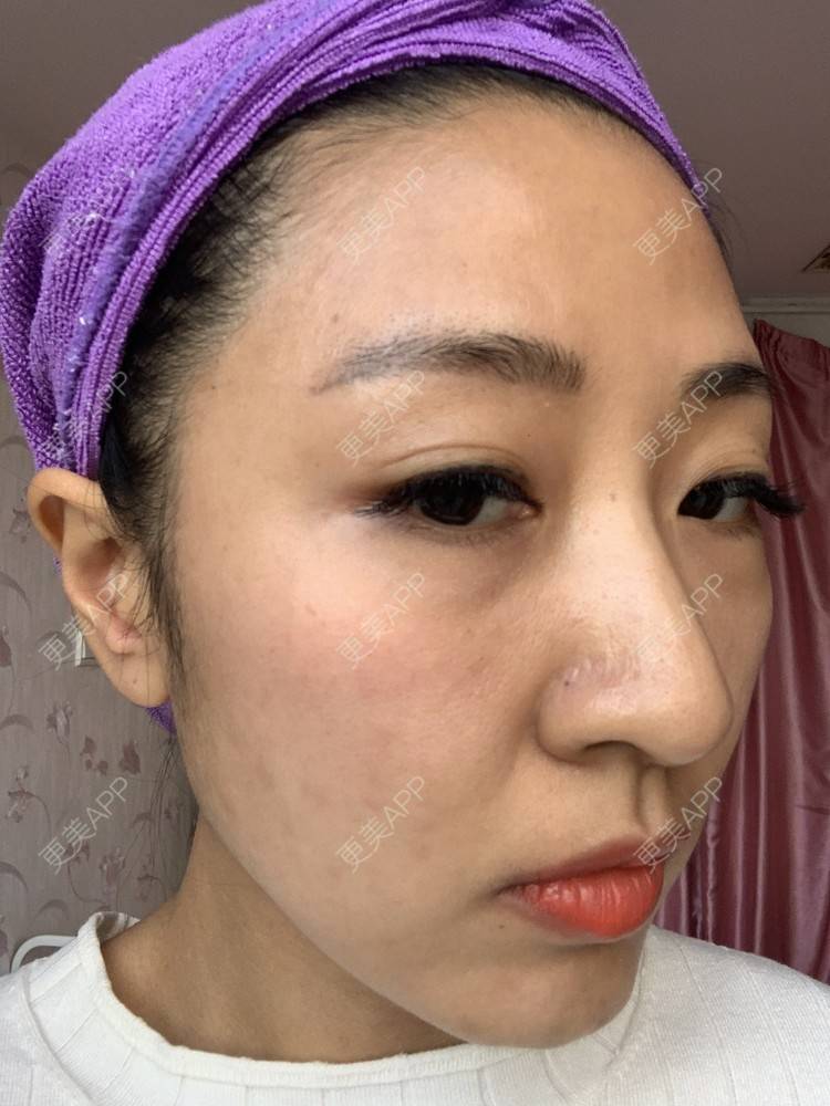 更美 - 房小丫的水光项目经验 | 水光项目 | 天津 | 微针水光