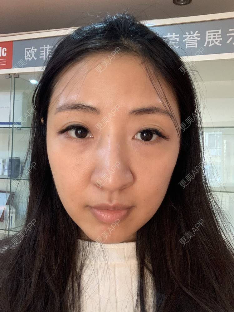 更美 - 房小丫的水光项目经验 | 水光项目 | 天津 | 微针水光