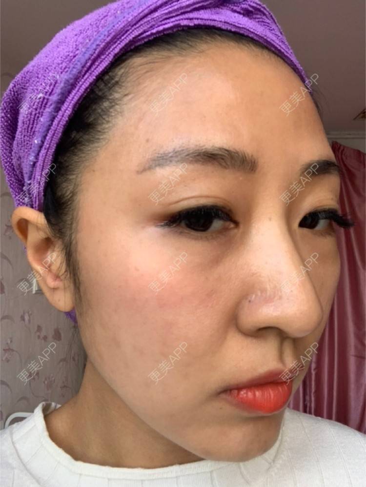 更美 - 房小丫的水光项目经验 | 天津 | 水光项目 | 微针水光