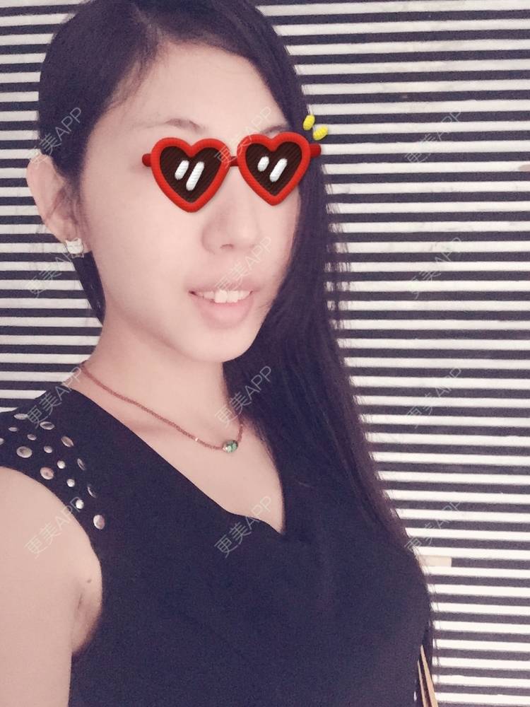 更美 - DarLing^_^的下巴截骨前移经验 | 下巴截骨 | 北京 | 下巴截骨前移