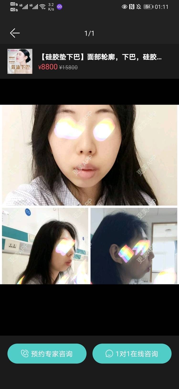 更美 - DarLing^_^的下巴截骨前移经验 | 下巴截骨 | 北京 | 下巴截骨前移