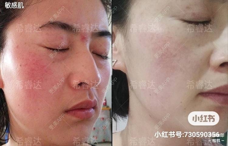 更美 - 悦丝汀，修复敏感肌的舒敏之星经验 | 舒敏之星 | 补水套餐 | 成都