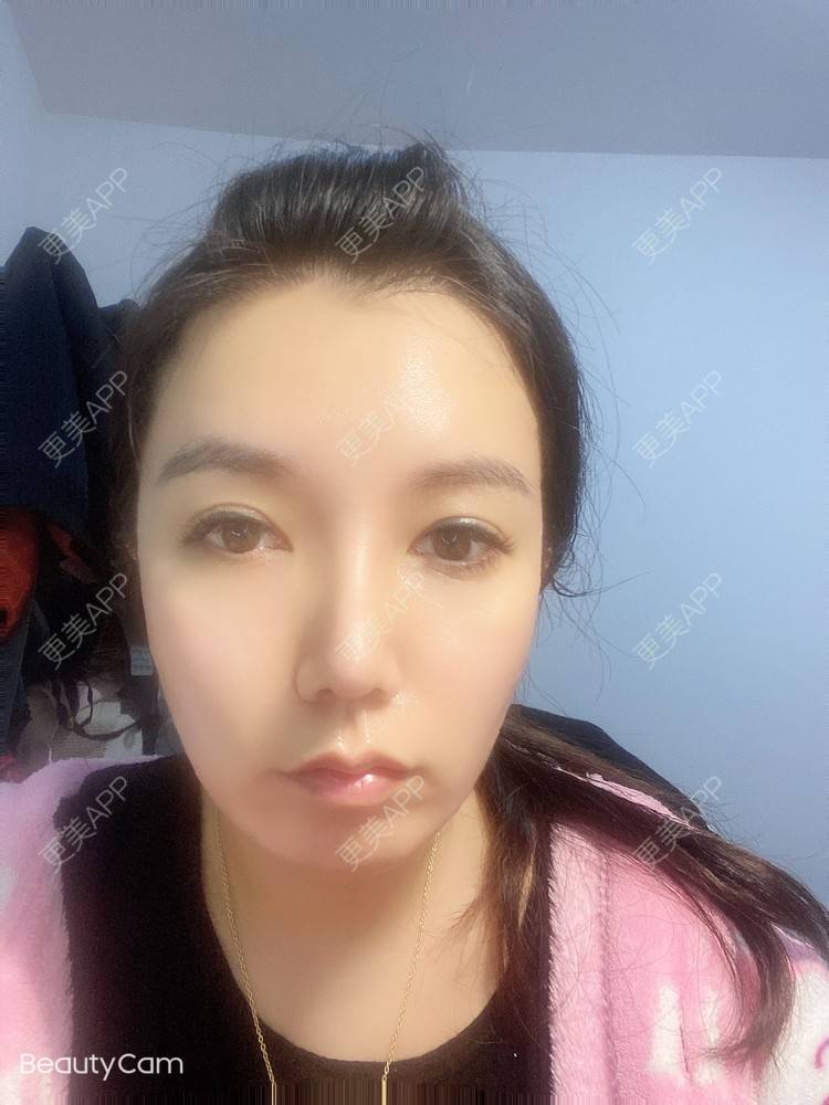 更美 - 傻傻傻分不清的硅胶垫下巴经验 | 硅胶垫下巴 | 上海