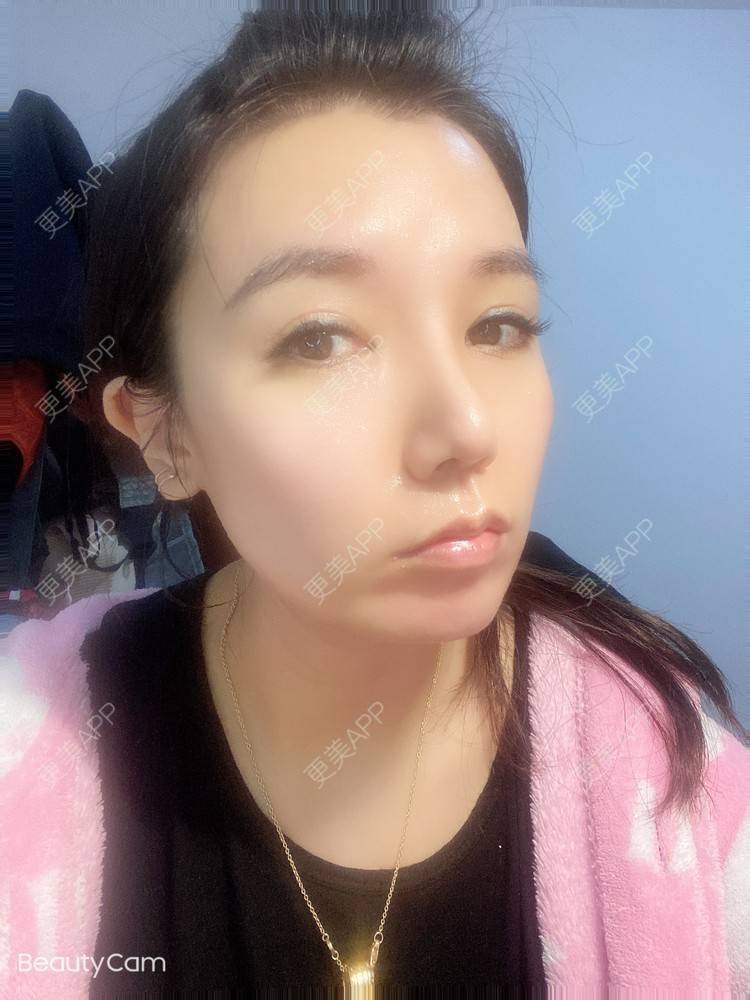 更美 - 傻傻傻分不清的硅胶垫下巴经验 | 硅胶垫下巴 | 上海