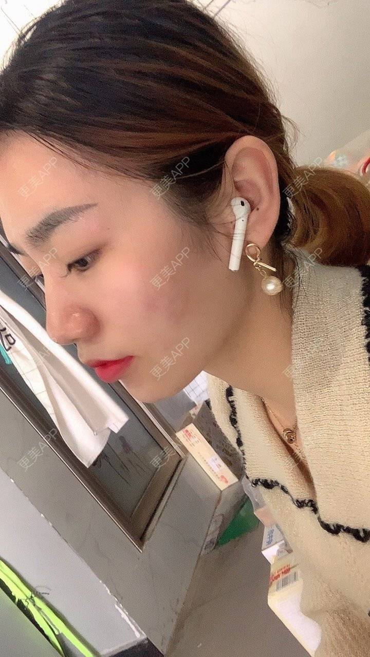 更美 - 更美用户9Ullrmnx3O的玻尿酸泪沟经验 | 玻尿酸泪沟 | 胶原蛋白丰泪沟
