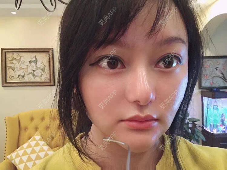 更美 - 三生有幸呀的硅胶垫下巴经验 | 硅胶垫下巴 | 膨体垫下巴 | 宽下巴矫正 | 下巴硅胶假体取出 | 下巴膨体假体取出