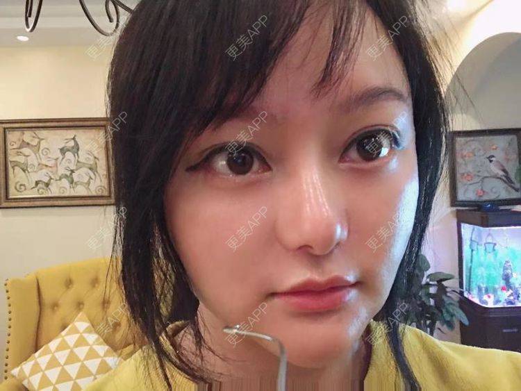 更美 - 三生有幸呀的硅胶垫下巴经验 | 硅胶垫下巴 | 膨体垫下巴 | 宽下巴矫正 | 下巴硅胶假体取出 | 下巴膨体假体取出