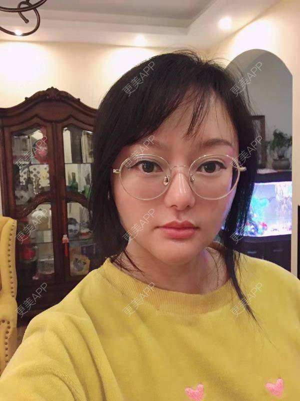 更美 - 三生有幸呀的硅胶垫下巴经验 | 硅胶垫下巴 | 膨体垫下巴 | 宽下巴矫正 | 下巴硅胶假体取出 | 下巴膨体假体取出
