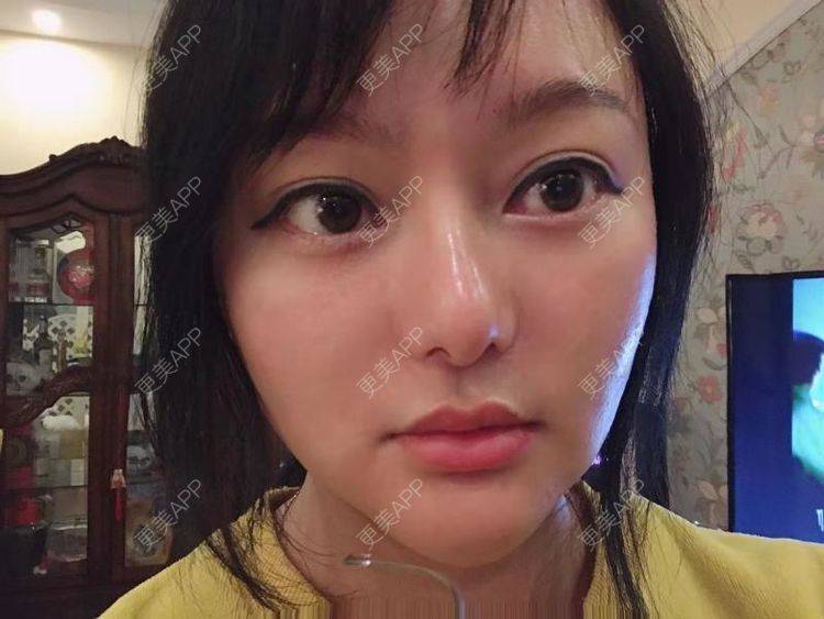 更美 - 三生有幸呀的硅胶垫下巴经验 | 硅胶垫下巴 | 膨体垫下巴 | 宽下巴矫正 | 下巴硅胶假体取出 | 下巴膨体假体取出
