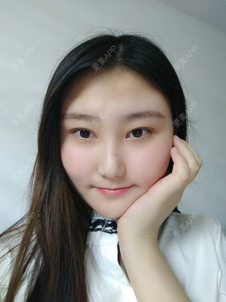 更美 - 更美用户zLnEttFeDx的热玛吉经验 | 广州 | 热玛吉