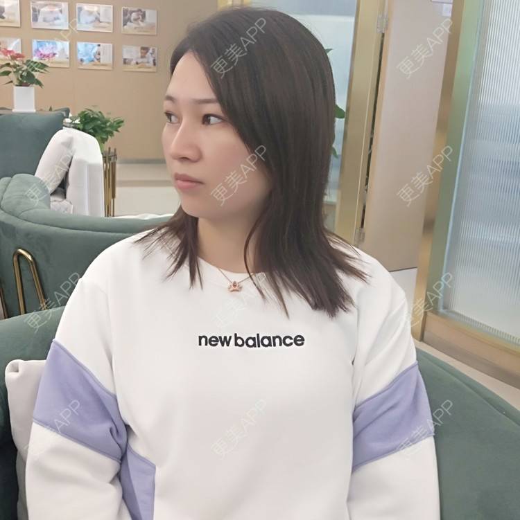 更美 - 优美酱的鼻部多项经验 | 肋软骨隆鼻 | 鼻部多项 | 鼻小柱延长 | 鼻部膨体假体取出 | 自体肋软骨垫鼻基底