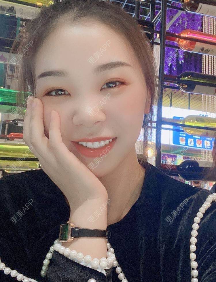更美 - 河南美时美刻医疗美容的全切双眼皮经验 | 全切双眼皮