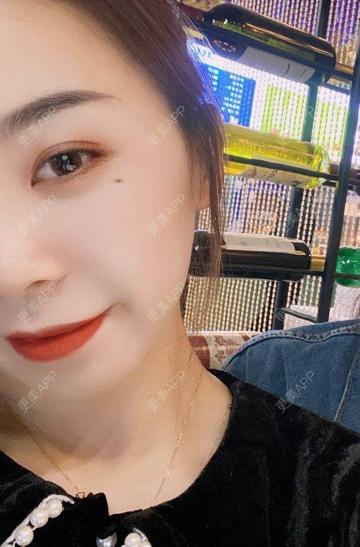 更美 - 河南美时美刻医疗美容的全切双眼皮经验 | 全切双眼皮