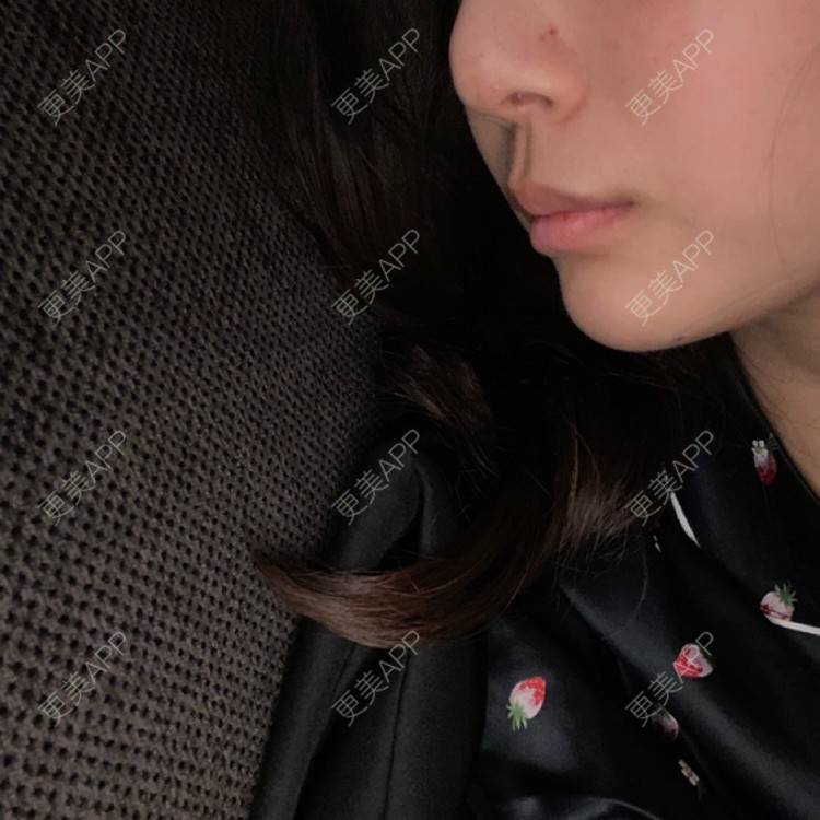 更美 - 更美用户d65C1Kop7A的玻尿酸鼻部经验 | 玻尿酸鼻部 | 上海