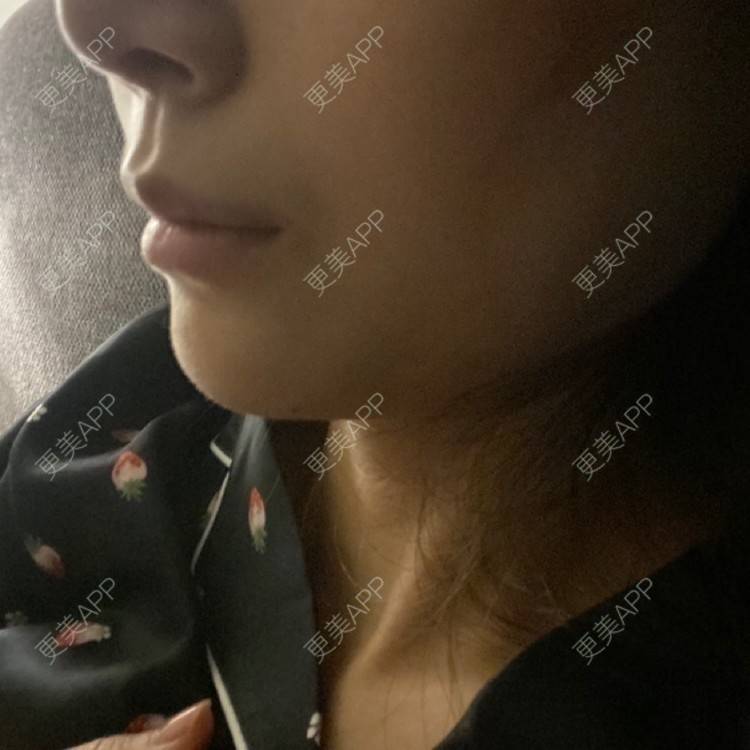 更美 - 更美用户d65C1Kop7A的玻尿酸鼻部经验 | 玻尿酸鼻部 | 上海