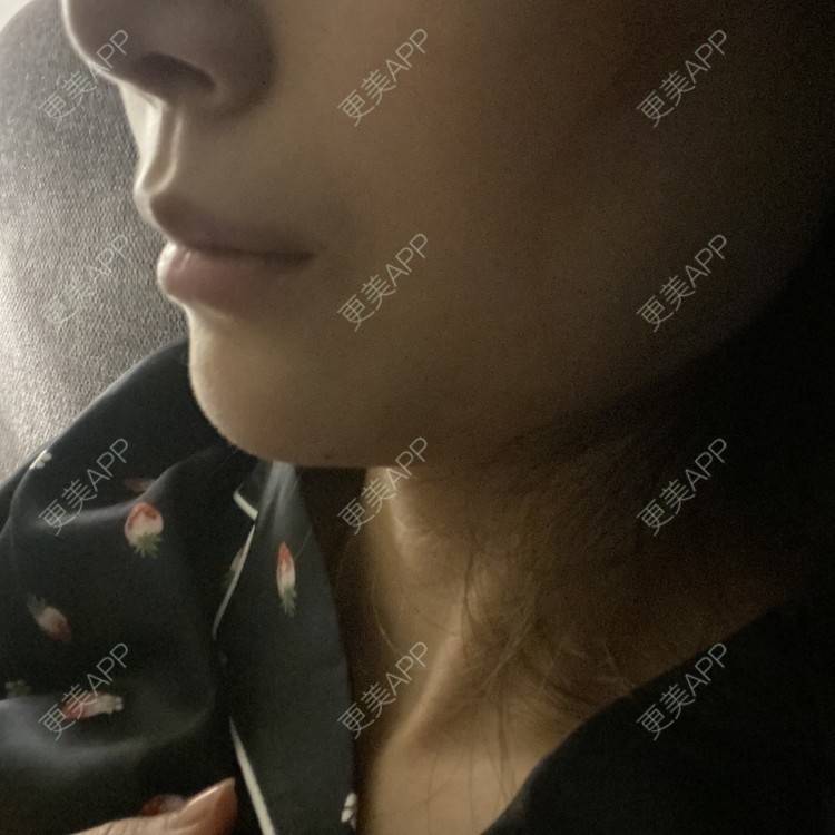 更美 - 更美用户d65C1Kop7A的玻尿酸鼻部经验 | 玻尿酸鼻部 | 上海