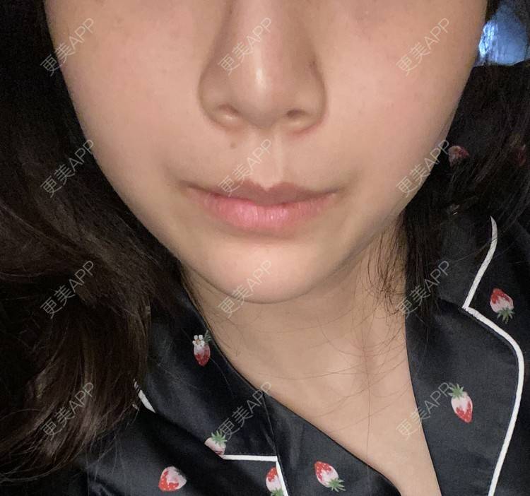 更美 - 更美用户d65C1Kop7A的玻尿酸鼻部经验 | 玻尿酸鼻部 | 上海