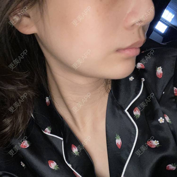 更美 - 更美用户d65C1Kop7A的玻尿酸鼻部经验 | 玻尿酸鼻部 | 上海