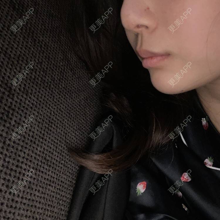 更美 - 更美用户d65C1Kop7A的玻尿酸鼻部经验 | 玻尿酸鼻部 | 上海