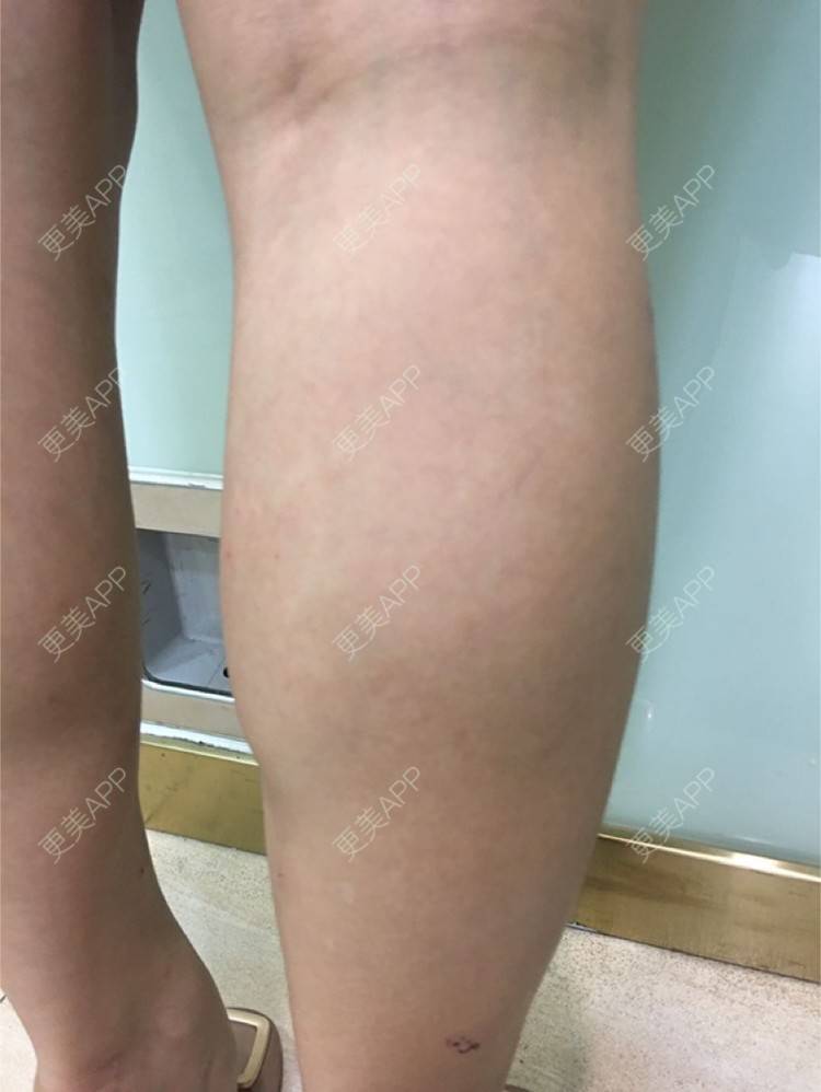 更美 - 更美用户d65C1Kop7A的注射塑形腿部经验 | 注射塑形腿部 | 上海