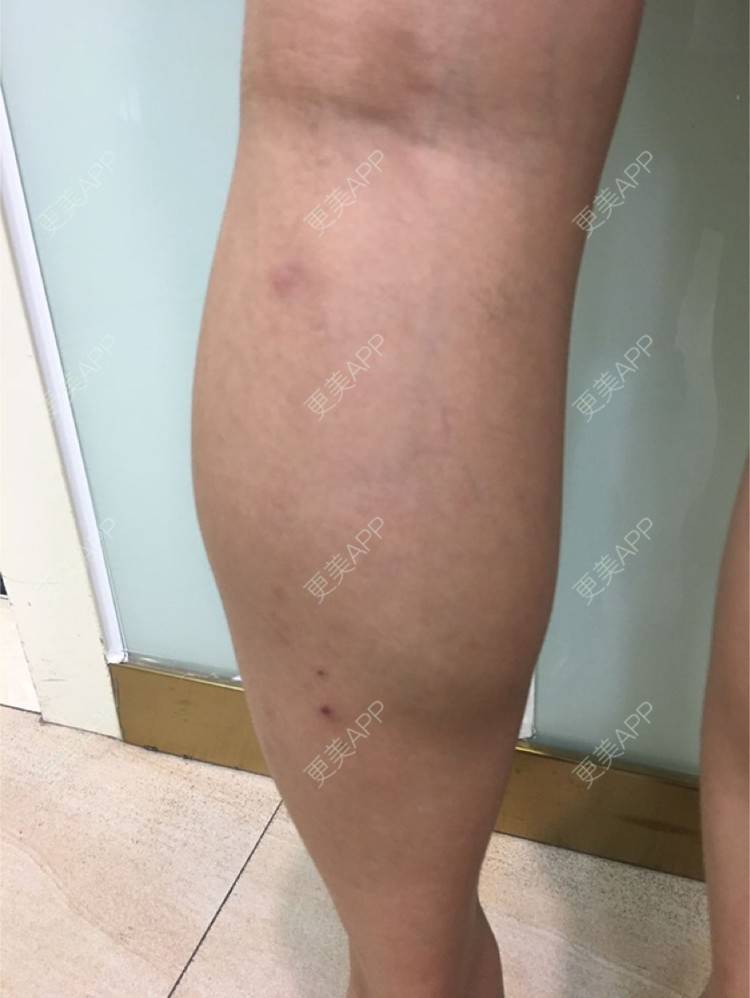 更美 - 更美用户d65C1Kop7A的注射塑形腿部经验 | 注射塑形腿部 | 上海