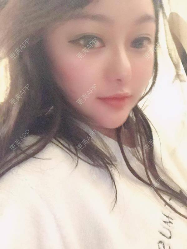更美 - 三生有幸呀的硅胶垫下巴经验 | 硅胶垫下巴 | 膨体垫下巴 | 宽下巴矫正 | 下巴硅胶假体取出 | 下巴膨体假体取出