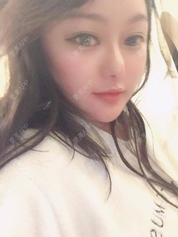 更美 - 三生有幸呀的硅胶垫下巴经验 | 硅胶垫下巴 | 膨体垫下巴 | 宽下巴矫正 | 下巴硅胶假体取出 | 下巴膨体假体取出