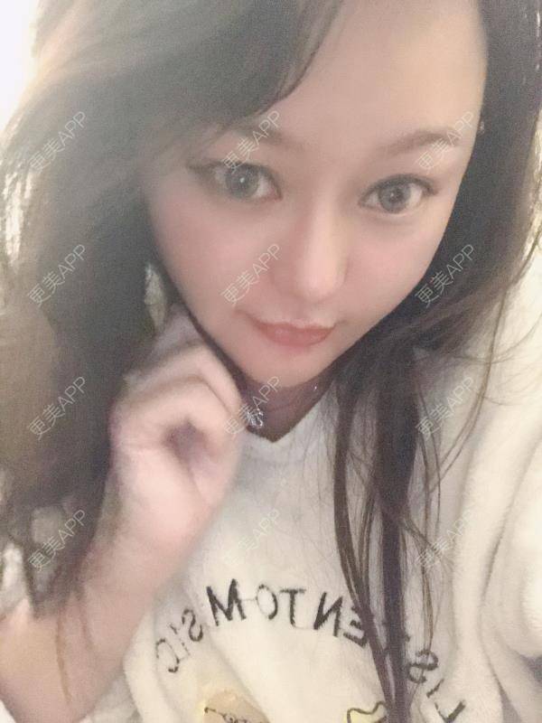 更美 - 三生有幸呀的硅胶垫下巴经验 | 硅胶垫下巴 | 膨体垫下巴 | 宽下巴矫正 | 下巴硅胶假体取出 | 下巴膨体假体取出