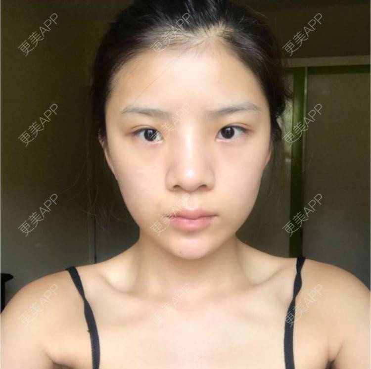 更美 - 杨小雯bb的肋软骨隆鼻经验 | 肋软骨隆鼻 | 深圳