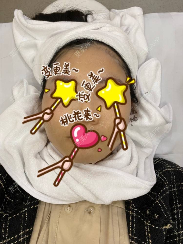 更美 - 艾莉婕15的光子嫩肤经验 | 舒敏之星 | 皮肤综合管理套餐 | 光子嫩肤 | 水氧活肤 | 清洁水光补水 | 南昌 | 补水套餐