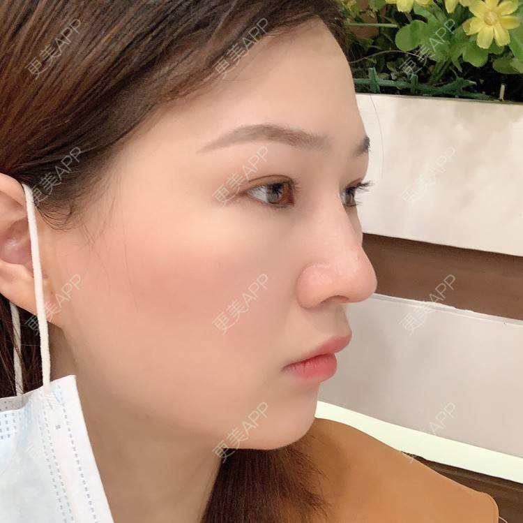更美 - 优美酱的鼻部多项经验 | 肋软骨隆鼻 | 自体肋软骨垫鼻基底 | 鼻部多项 | 鼻小柱延长 | 鼻部膨体假体取出