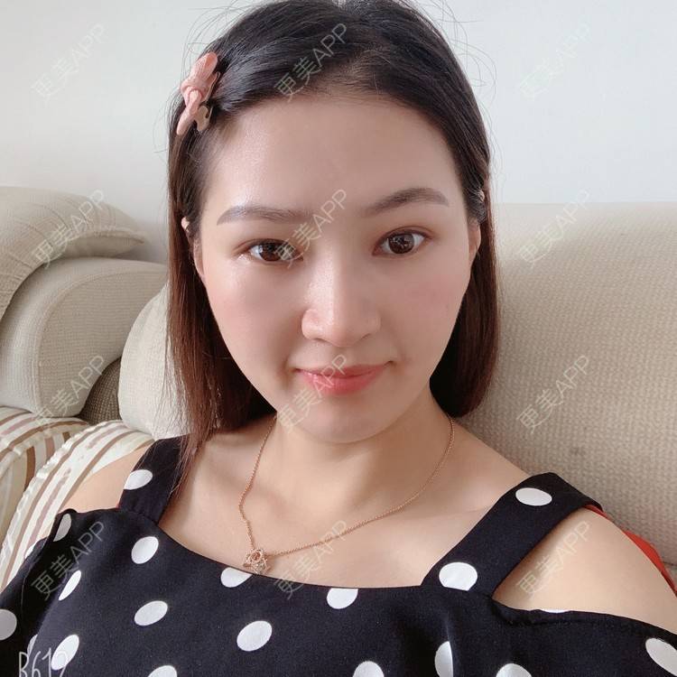 更美 - 优美酱的鼻部多项经验 | 肋软骨隆鼻 | 自体肋软骨垫鼻基底 | 鼻部多项 | 鼻小柱延长 | 鼻部膨体假体取出