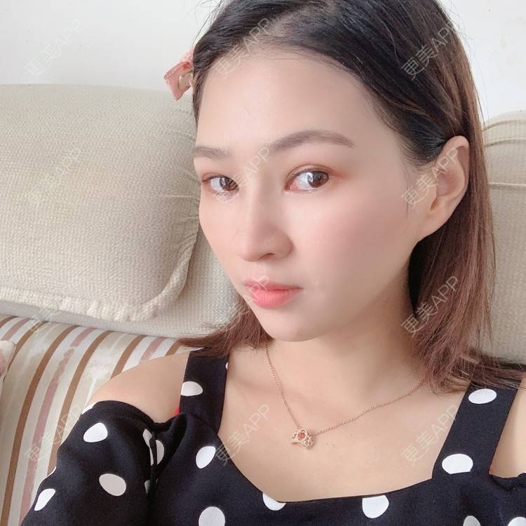 更美 - 优美酱的鼻部多项经验 | 肋软骨隆鼻 | 自体肋软骨垫鼻基底 | 鼻部多项 | 鼻小柱延长 | 鼻部膨体假体取出